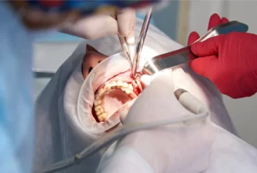 Foods to eat after dental implant surgery